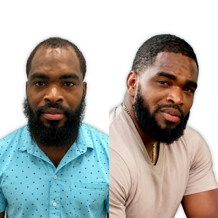 Before and after Sapphire FUE — 4,200 grafts, patient from London